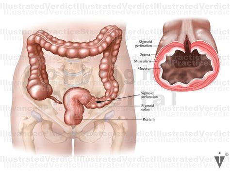 Sections Of The Colon