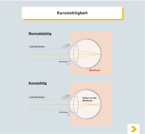 Kurzsichtigkeit Myopie Erkennen Und Frühzeitig Behandeln