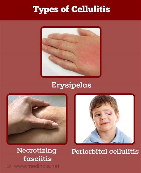 Cellulitis Rash Stages