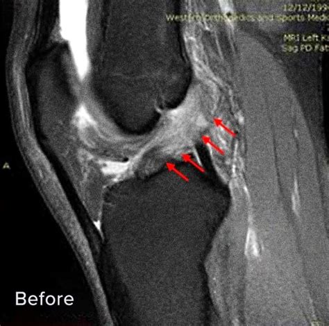 Regenexx Non-Surgical Treatment for ACL Tear in Colorado