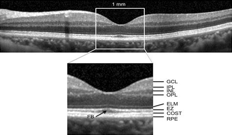 Optical Coherence Tomography Predictors Of Short Term Visual Retina