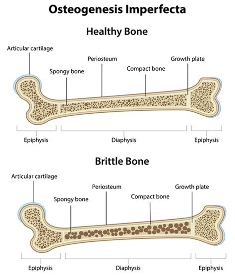 Osteogenesis Imperfecta (OI): Causes, Signs and Symptoms, Diagnosis and ...