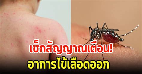 Recognizing Dengue Fever Warning Signs And What To Do News Directory 3