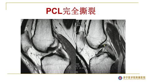 图文并茂膝关节MRI解剖及常见病诊断 MedSci cn