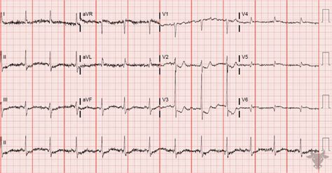 Posterior Myocardial Infarction | ECG Stampede