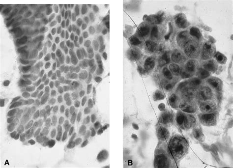 Endometrial Hyperplasia Histology