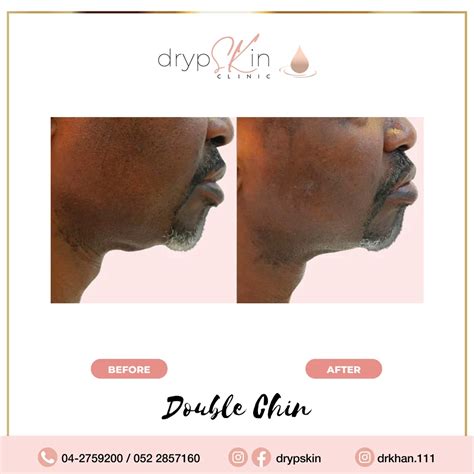 Double Chin Removal Dubai | Double Chin Treatment | drypSKin