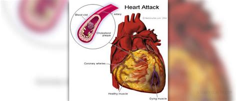 Symptoms of myocardial infarction | General center | SteadyHealth.com