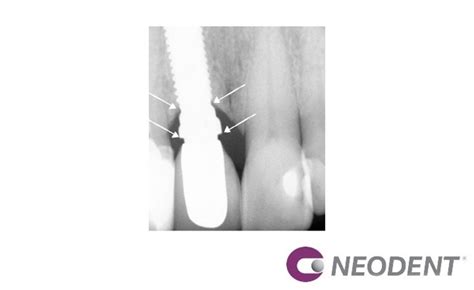 Cirurgia Guiada Ngs Para A Instala O Do Helix Gm Carga Imediata