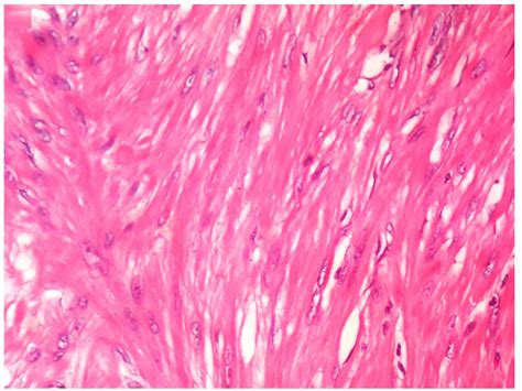 Section Shows Interlacing Fascicles Of Spindle Cells Showing