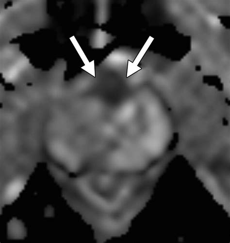 Anterior Prostate Cancer Diagnostic Performance Of T2 Weighted MRI And