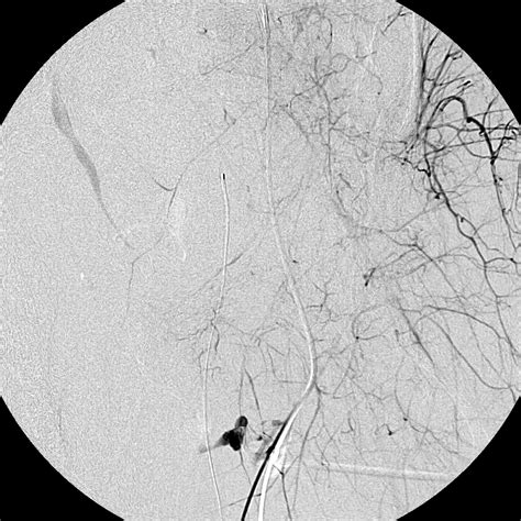 Trauma Embolization Case Albany Ir