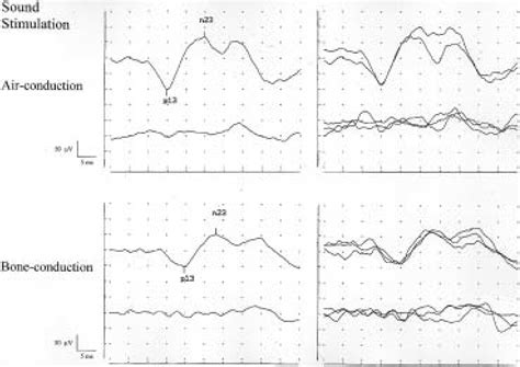 Vemp In Response To Ipsilateral Sound Stimulation In The Patient