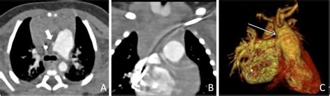 Case Report Of Rare Congenital Cardiovascular Anomalies Associated With