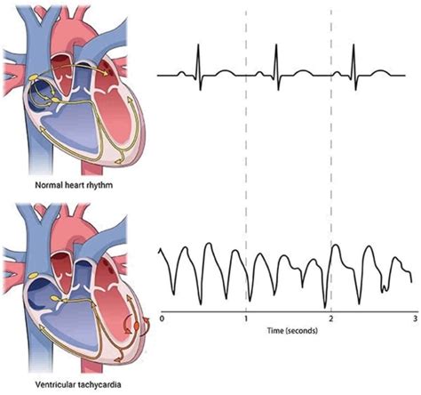 Ventricular Tachycardia Vt Ablation In Structural Heart Disease Rhythm And Cardiac Specialists