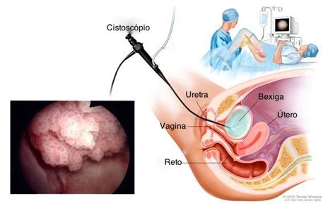 Dos Tumores De Bexiga S O Neoplasias Uroteliais