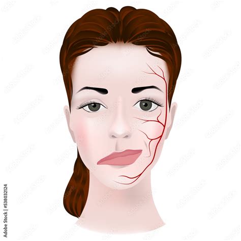 Myasthenia. Woman's twisted face. Damage to the triadic nerve and ...