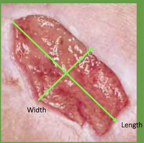 Chapter 3 Wound Care Exam 1 Flashcards Quizlet