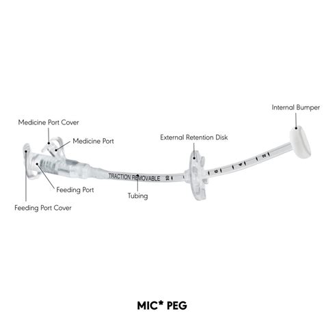 Sonde de gastrostomie percutanée endoscopique sonde de GPE TubeFed