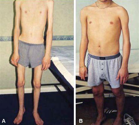 Figure From Molecular And Cellular Basis Of Calpainopathy Limb