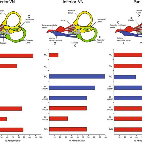 Distribution Of Vestibular Tests With Vestibular Neuritis Vn Download Scientific Diagram