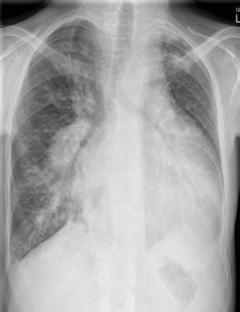 Unilateral Pulmonary Edema Blalock Taussig Shunt In Pulmonary Atresia