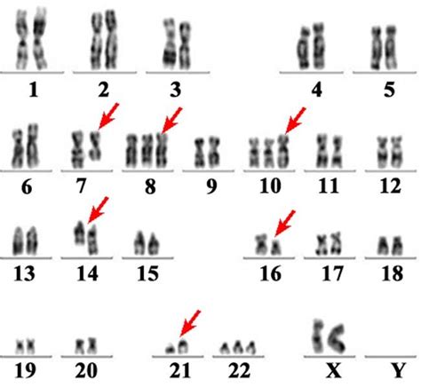 G Banding Karyotype Analysis Of Bone Marrow Showing Complex Karyotypic