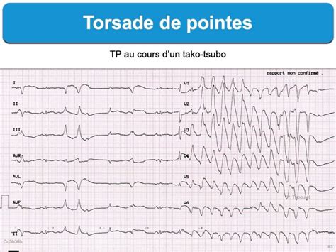 Torsade De Pointes E Cardiogram