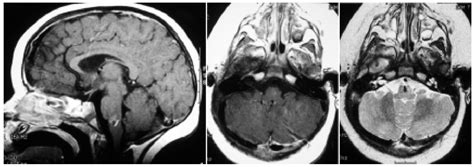 Intrinsic Brainstem Epidermoid Cyst In Journal Of Neurosurgery