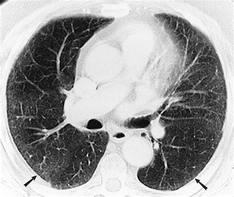 Pulmonary Drug Toxicity Radiologic And Pathologic Manifestations