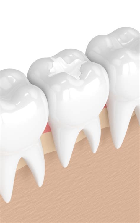 White Composite Fillings Aberdeen Old Town Dental Care