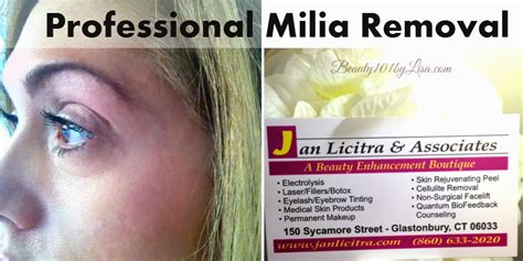 BEAUTY101BYLISA: MILIA REMOVAL From EYE