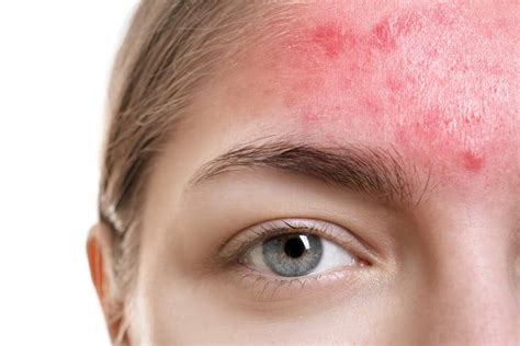 Learn How To Treat Acne Rosacea & Key Differences to Acne