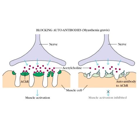 Myasthenia Gravis - Silicon Beach Medical Center