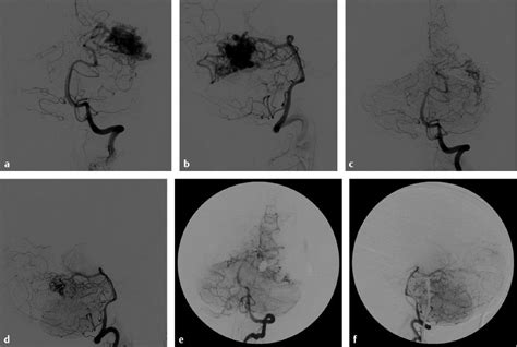 Natural History Clinical Presentation And Indications For Treatment Of Brain Arteriovenous