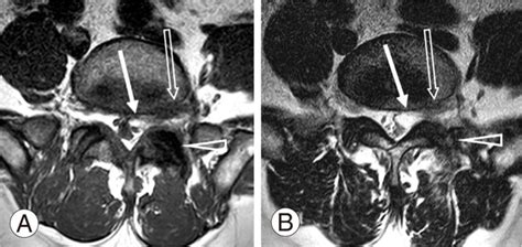 T1 Weighted A And T2 Weighted B Axial Magnetic Resonance Images At