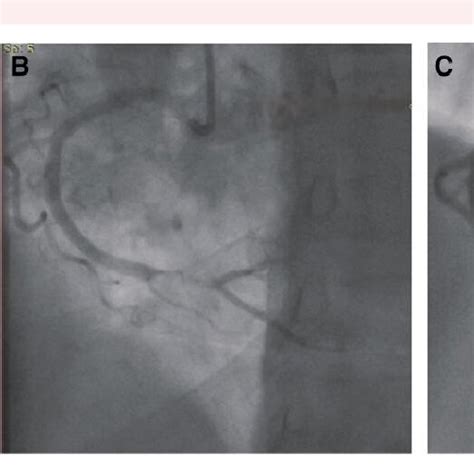 Initial coronary angiogram shows no obstructive coronary disease in the ...