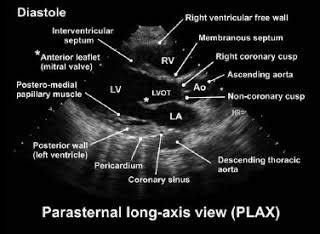 Parasternal Long Axis View - Joy-has-Morgan