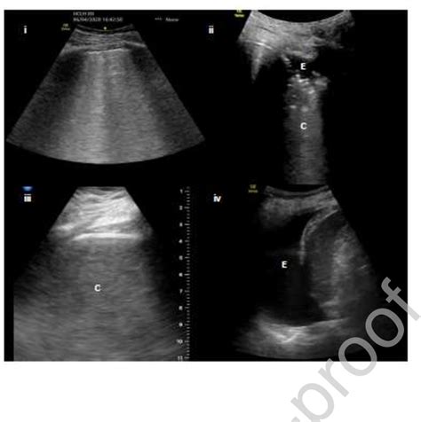 Figure From The Use Of Point Of Care Lung Ultrasound And