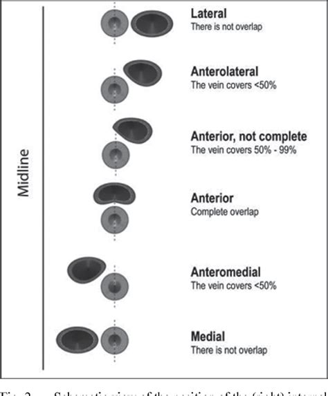 Pdf Internal Jugular Vein Location And Anatomy On Ultrasound