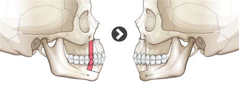 Mouth Protrusion Surgery : For a natural mouth shape 【ID Hospital】