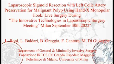 Laparoscopic Sigmoid Resection With Left Colic Artery Preservation For Malignant Polyp Youtube