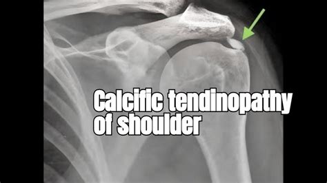 Rotator Cuff Calcific Tendinopathy Everything You Need To Know YouTube