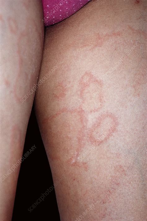 Rash On Thigh