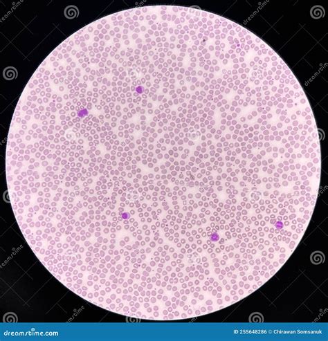 Normochromic and Normocytic Rbc Blood Smear Stock Photo - Image of ...