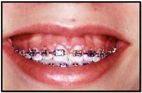 Gingival Hyperplasia With Braces