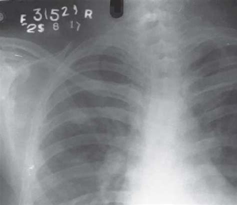 Chest Radiograph Postero Anterio View Showing Bilateral Nodular