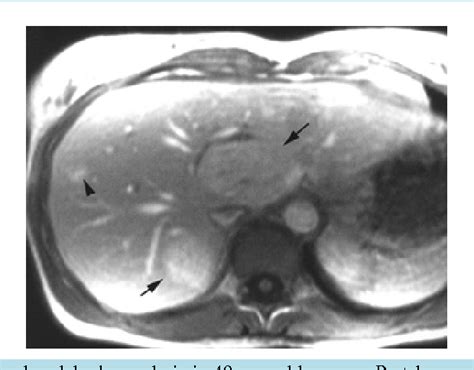 Figure 5 From Atypical CT And MRI Features Of Focal Nodular Hyperplasia