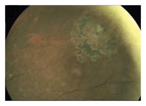 Peripheral SD OCT Before And After Laser Retinopexy For Cystic Retinal