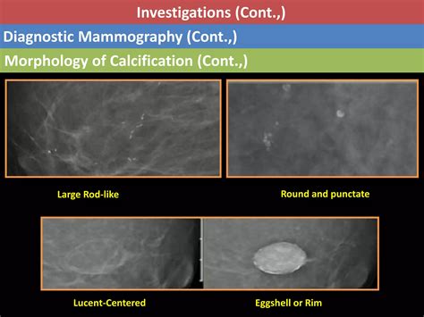 Ductal Carcinoma In Situ Dcis Ppt